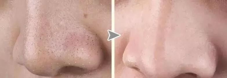 日本草莓鼻去黑头最有效的产品,byebye草莓鼻去黑头神器大揭秘