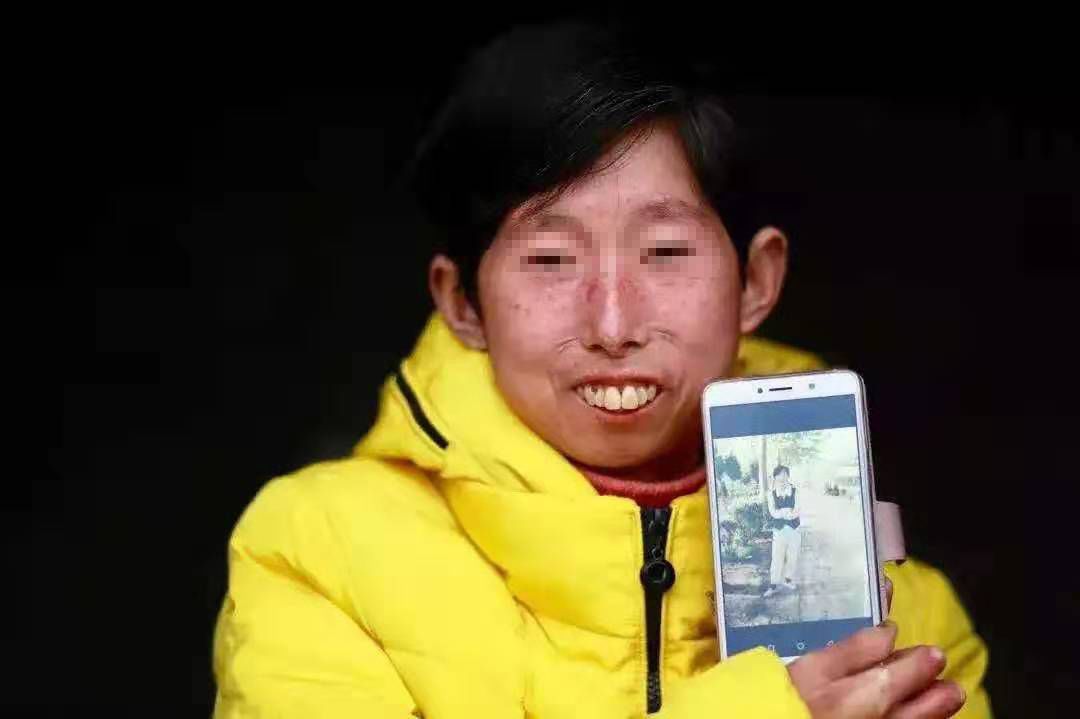 20岁女子罕见怪病一夜变老,22岁女子患罕见怪病