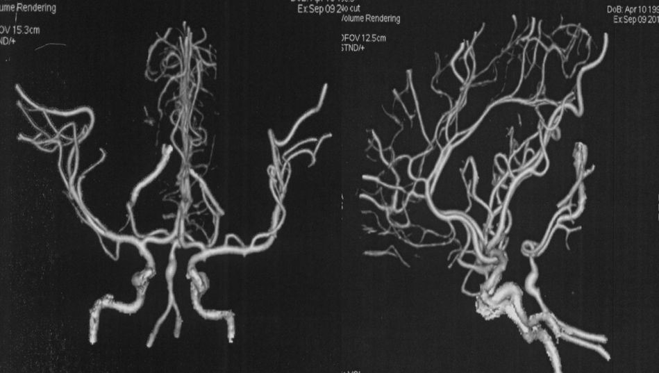 穆如清风·第13期｜Tubridge治疗基底动脉巨大夹层动脉瘤