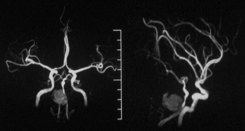穆如清风·第13期｜Tubridge治疗基底动脉巨大夹层动脉瘤