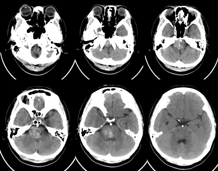 穆如清风·第13期｜Tubridge治疗基底动脉巨大夹层动脉瘤