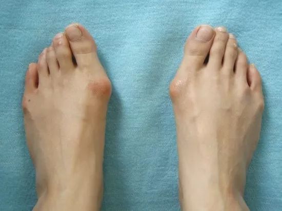 鸭脚板和扁平足的区别,鸭脚板是不是扁平足