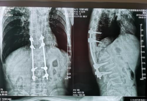 长春市传染病医院治疗皮肤结核,长春结核病医院院内感染