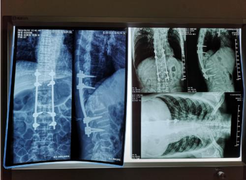 长春市传染病医院治疗皮肤结核,长春结核病医院院内感染