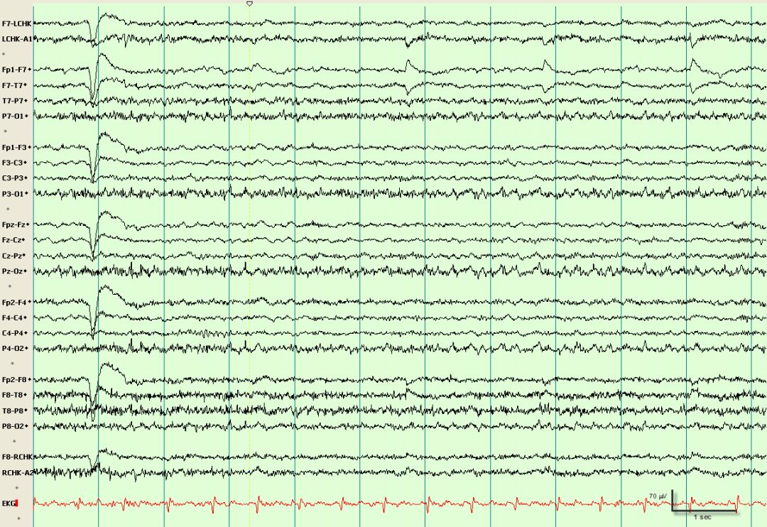脑电图伪差图,脑电图伪差图谱