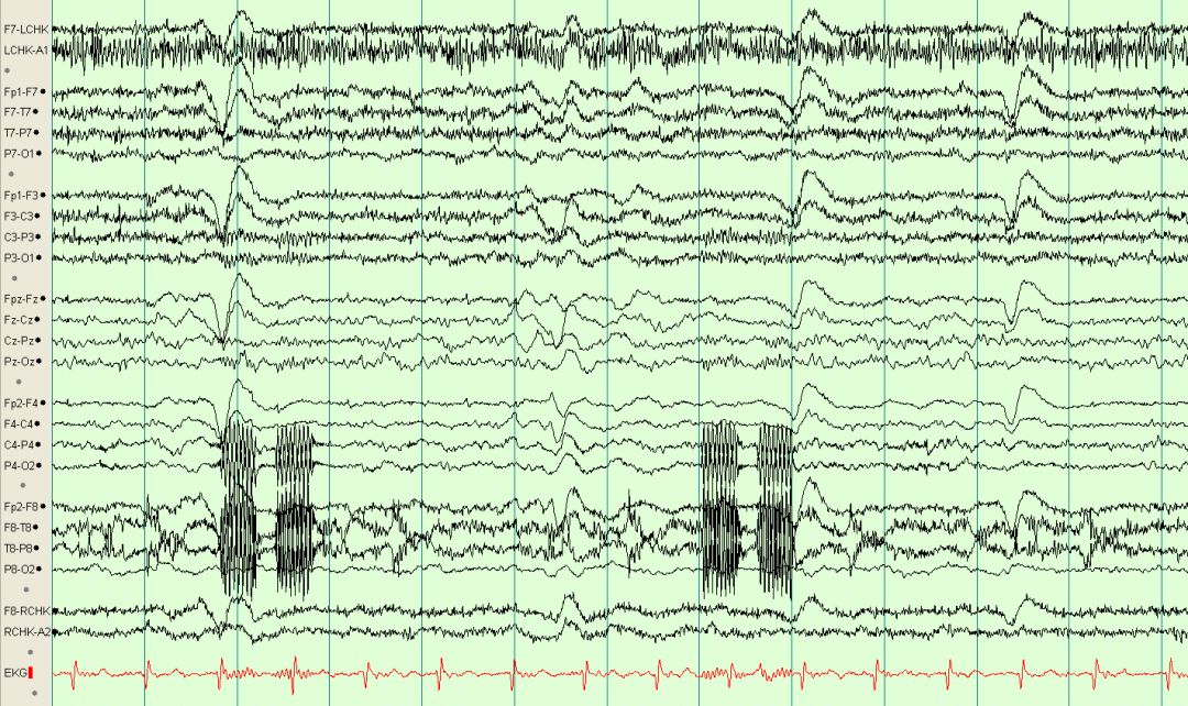 脑电图伪差图,脑电图伪差图谱