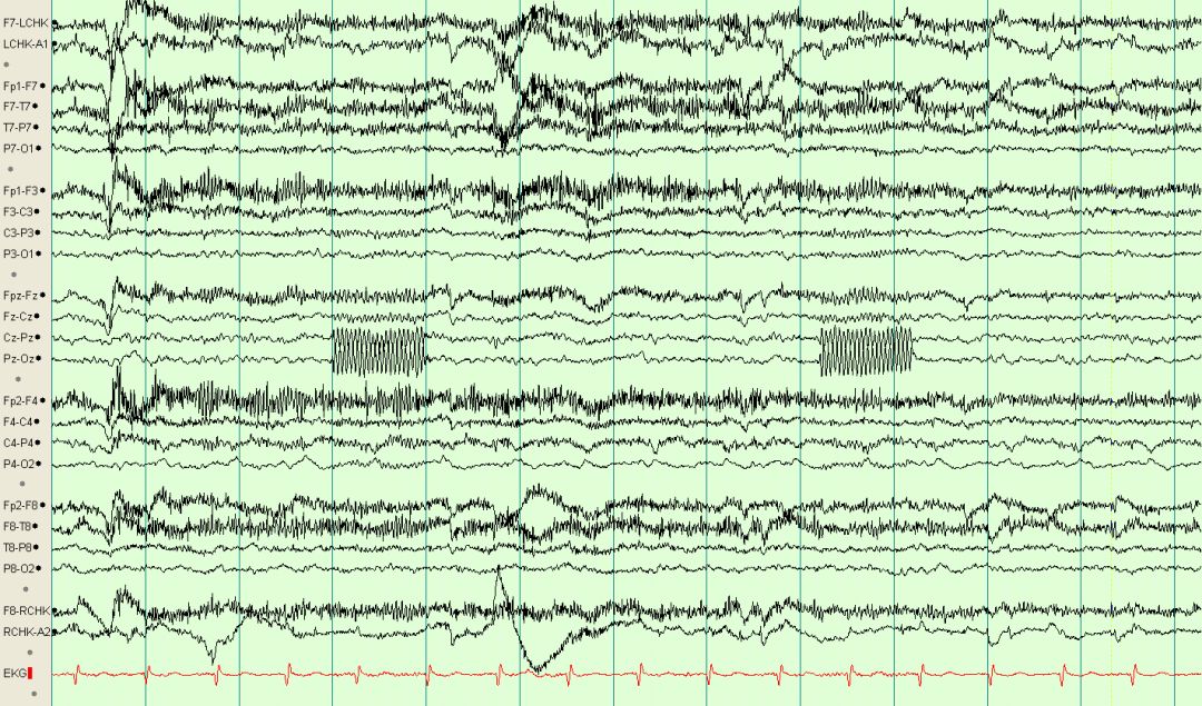 脑电图伪差图,脑电图伪差图谱