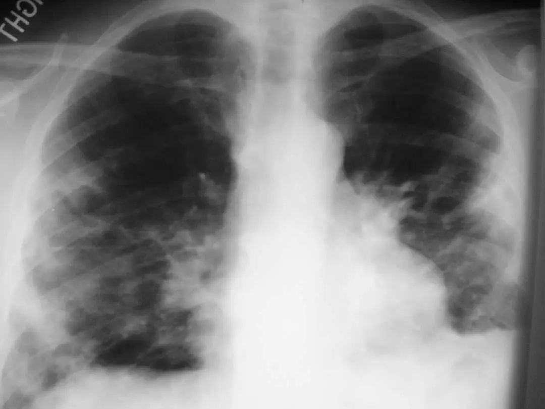 26张图，搞懂细菌性肺炎与病毒性肺炎