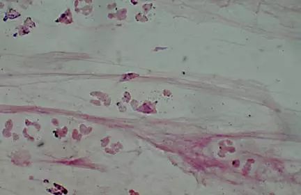 26张图，搞懂细菌性肺炎与病毒性肺炎