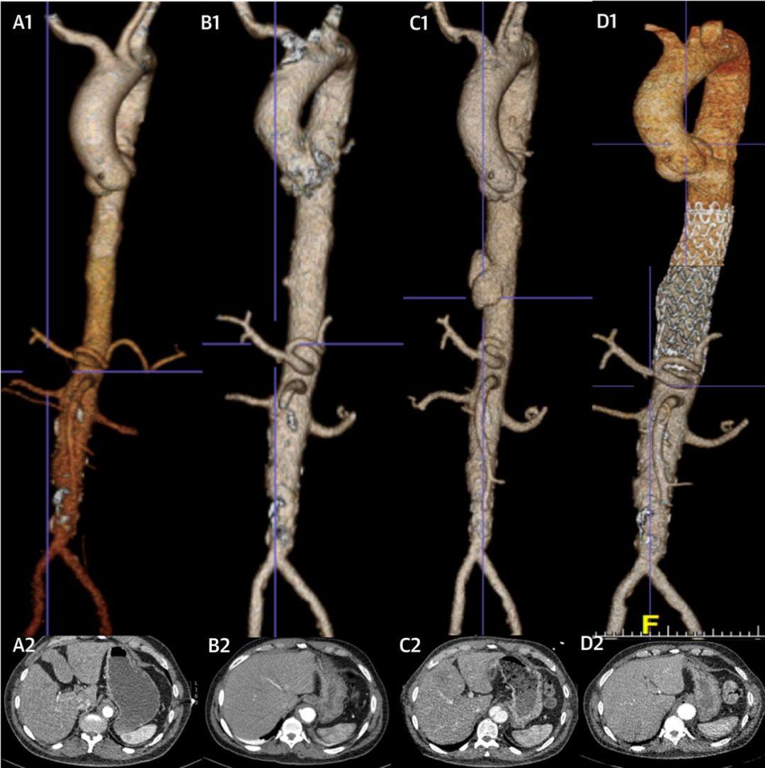 急性主动脉综合征怎么判断,急性主动脉综合征包含几种疾病