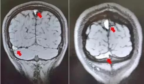 26岁小伙加班后头晕,28岁小伙熬夜加班49小时