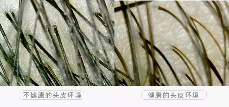 头皮痒头屑多有头螨怎么办,头螨大块头屑怎么治好得快