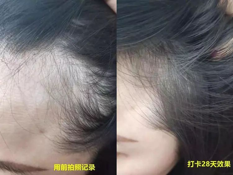 头皮痒头屑多有头螨怎么办,头螨大块头屑怎么治好得快