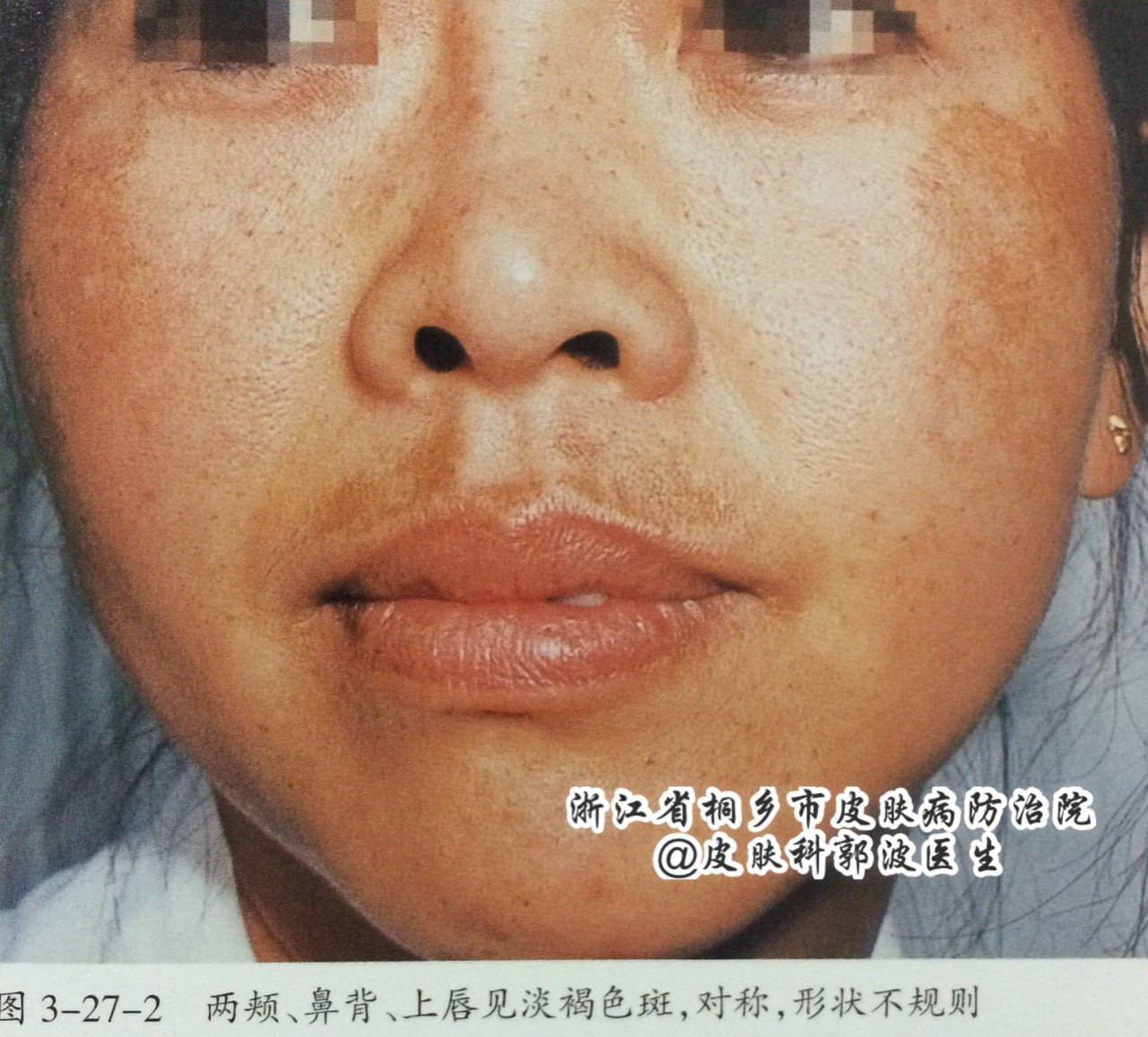 褐斑病是什么原因导致的,褐斑的原因和治疗方法