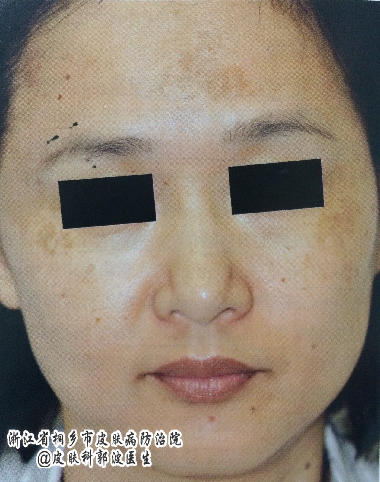 褐斑病是什么原因导致的,褐斑的原因和治疗方法