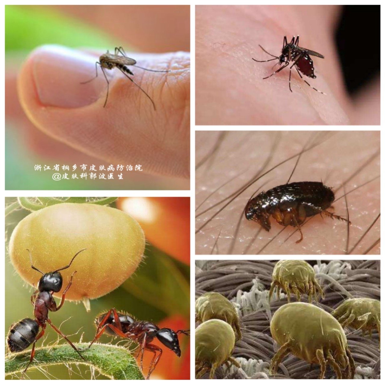 丘疹性荨麻疹的最佳图片,丘疹性荨麻疹防治措施