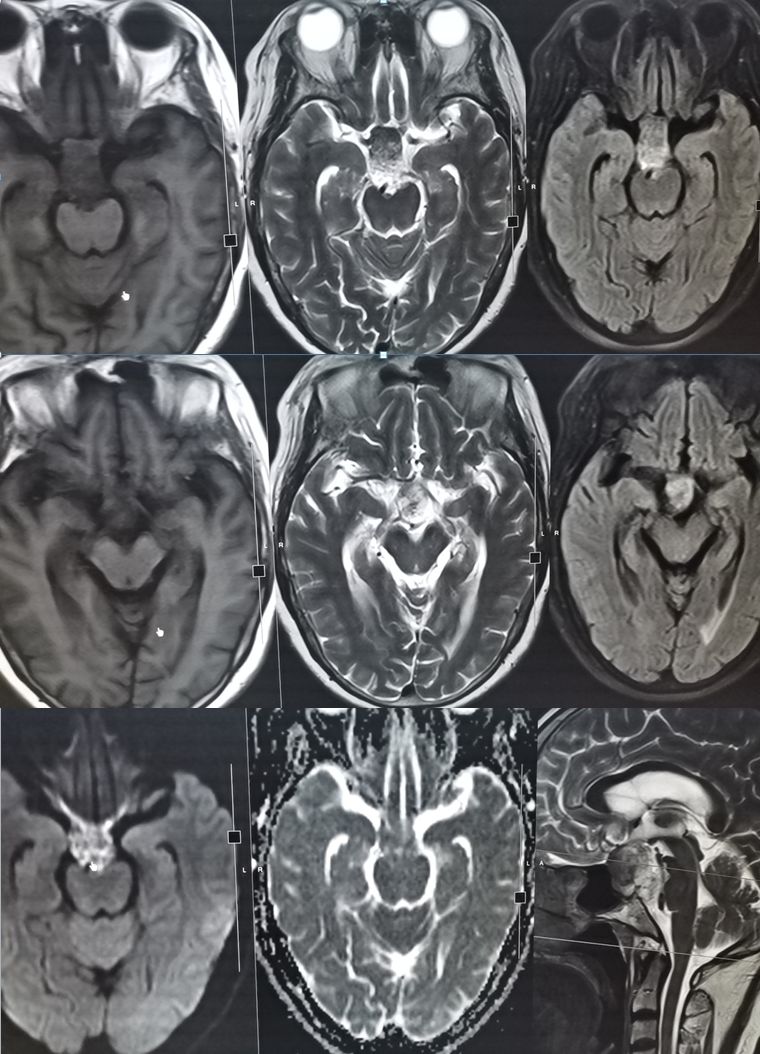 颈内动脉血栓和闭塞,颈内动脉漂浮血栓