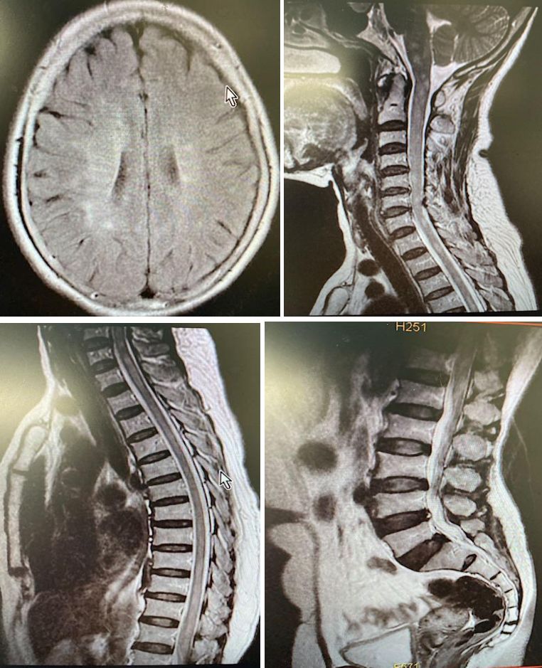颈内动脉血栓和闭塞,颈内动脉漂浮血栓