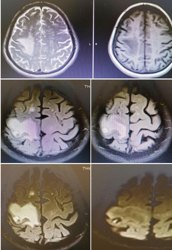 颈内动脉血栓和闭塞,颈内动脉漂浮血栓