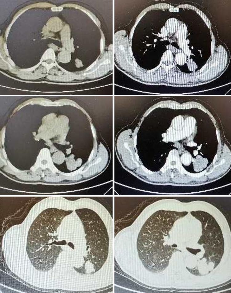 颈内动脉血栓和闭塞,颈内动脉漂浮血栓
