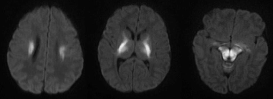 枫糖尿病、血管型梅毒、Hopkins综合征、Susac综合征丨3分钟读片·2期