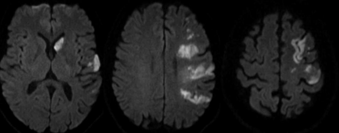 枫糖尿病、血管型梅毒、Hopkins综合征、Susac综合征丨3分钟读片·2期