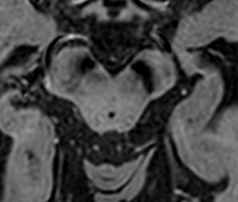 枫糖尿病、血管型梅毒、Hopkins综合征、Susac综合征丨3分钟读片·2期