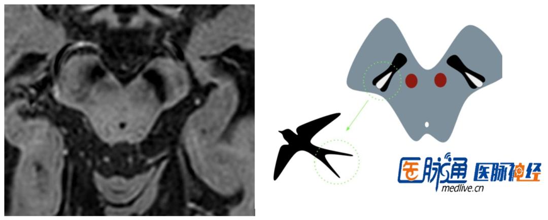 枫糖尿病、血管型梅毒、Hopkins综合征、Susac综合征丨3分钟读片·2期