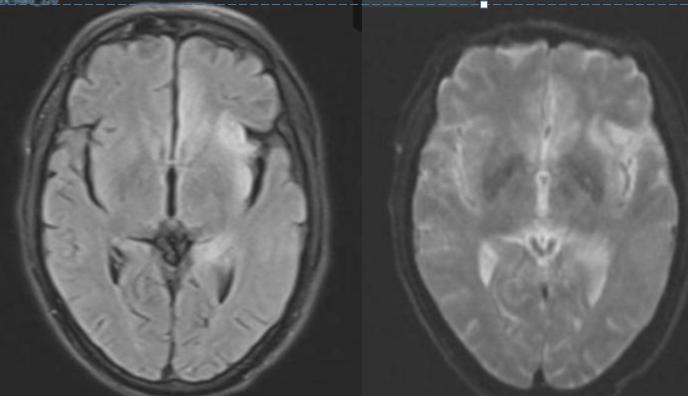 枫糖尿病、血管型梅毒、Hopkins综合征、Susac综合征丨3分钟读片·2期