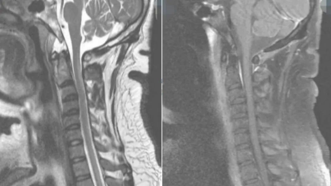 枫糖尿病、血管型梅毒、Hopkins综合征、Susac综合征丨3分钟读片·2期