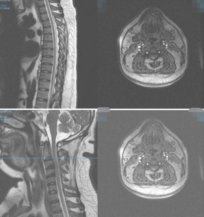 枫糖尿病、血管型梅毒、Hopkins综合征、Susac综合征丨3分钟读片·2期