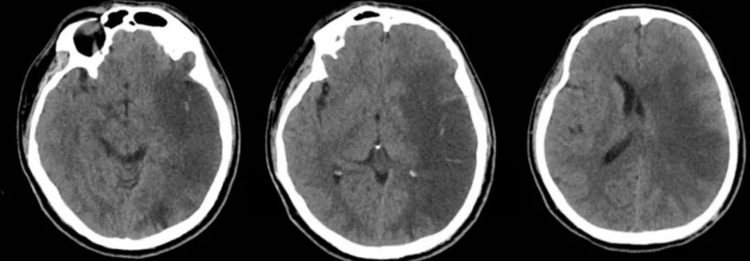 枫糖尿病、血管型梅毒、Hopkins综合征、Susac综合征丨3分钟读片·2期