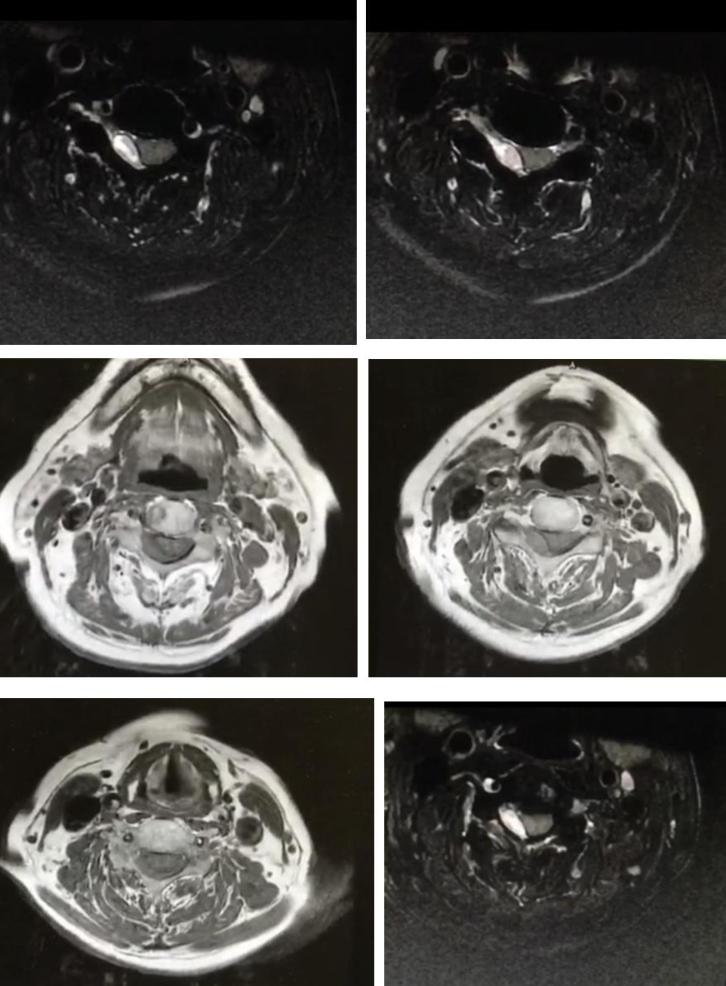 枫糖尿病、血管型梅毒、Hopkins综合征、Susac综合征丨3分钟读片·2期