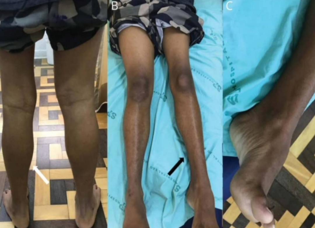 枫糖尿病、血管型梅毒、Hopkins综合征、Susac综合征丨3分钟读片·2期