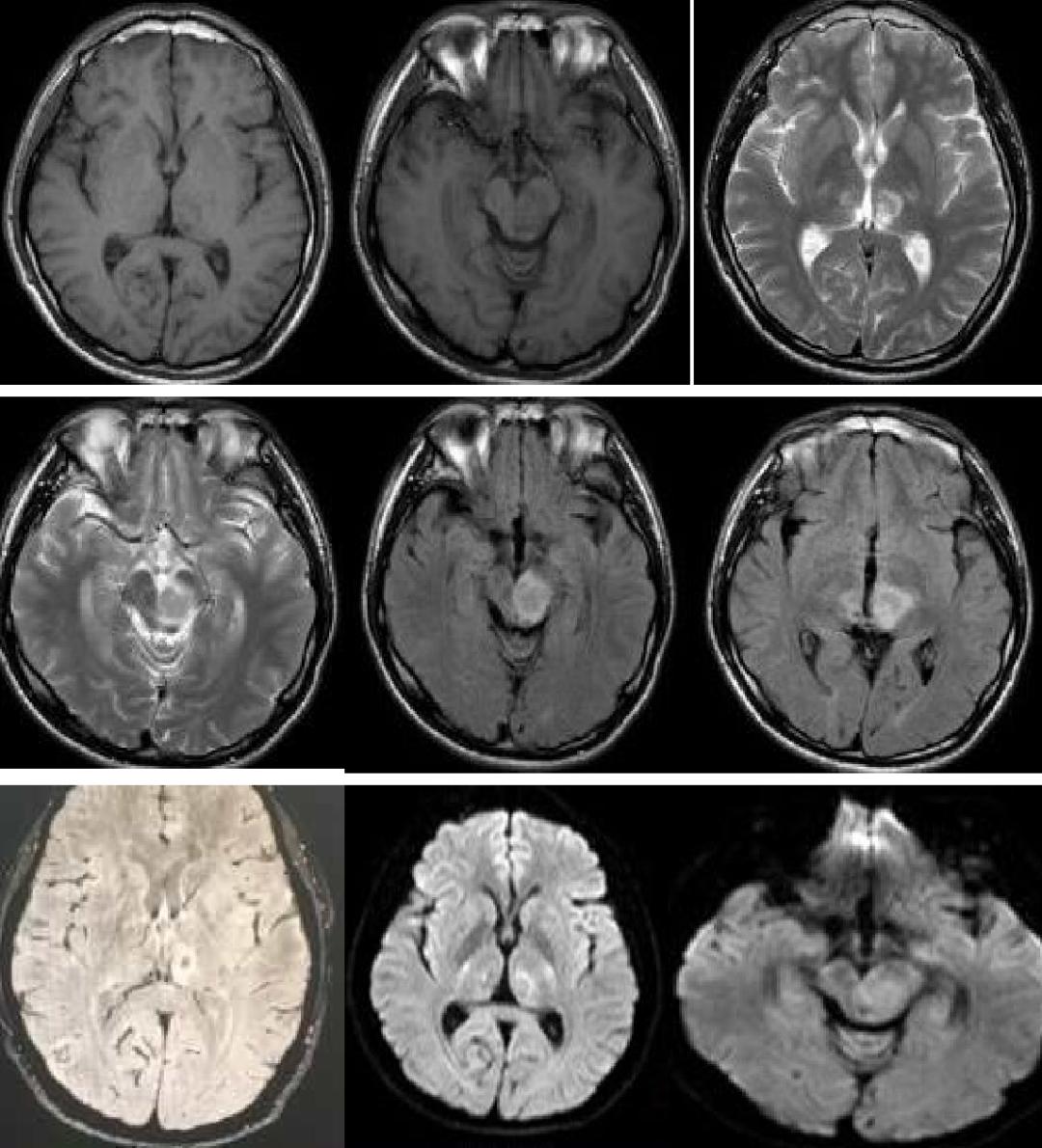 枫糖尿病、血管型梅毒、Hopkins综合征、Susac综合征丨3分钟读片·2期