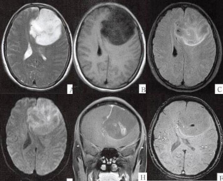 枫糖尿病、血管型梅毒、Hopkins综合征、Susac综合征丨3分钟读片·2期