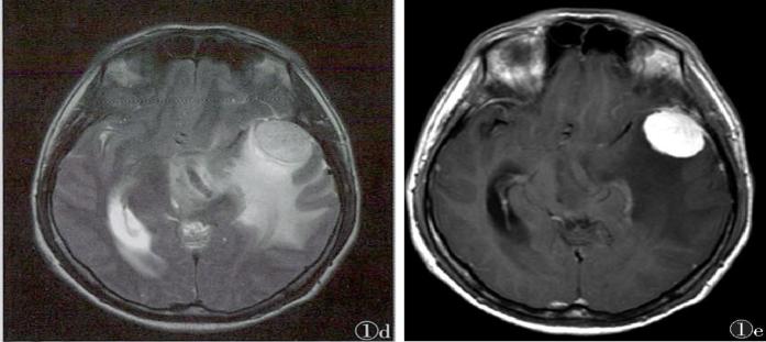 枫糖尿病、血管型梅毒、Hopkins综合征、Susac综合征丨3分钟读片·2期