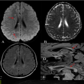 枫糖尿病、血管型梅毒、Hopkins综合征、Susac综合征丨3分钟读片·2期