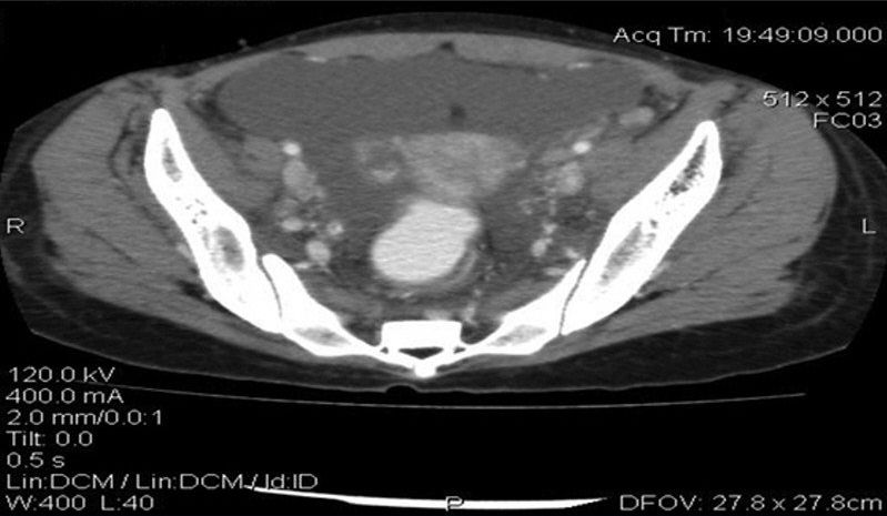 女性腹痛常见疾病,腹痛伴有腹水怎么回事