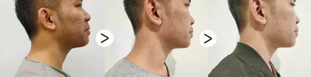 珊苏丽祛痘洁面皂,姗苏丽果酸洁面皂