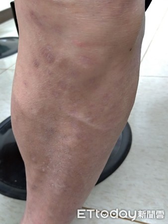 红疹破皮搔痒难耐　恼人湿疹痒3年中医调理半年止痒