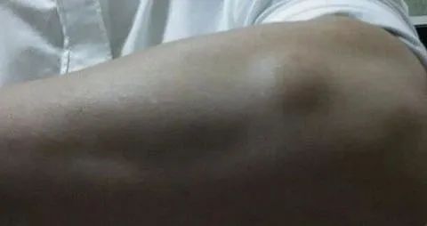 恶性肿瘤的4个早期信号,肿瘤最可怕的一种癌