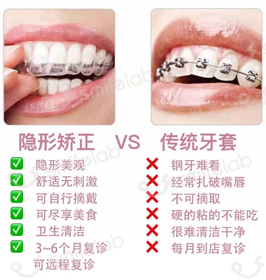 牙齿缝隙大隐形牙套矫正前后对比,牙齿前突隐形牙套矫正的全过程