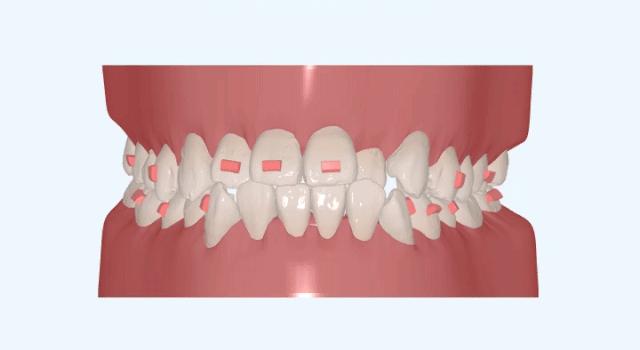 牙齿缝隙大隐形牙套矫正前后对比,牙齿前突隐形牙套矫正的全过程