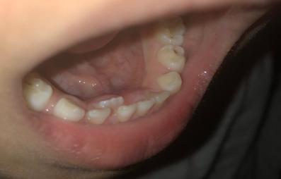 儿童换牙后牙齿长得不齐怎么办,换牙出现双排牙不齐怎么办