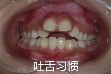 儿童换牙后牙齿长得不齐怎么办,换牙出现双排牙不齐怎么办
