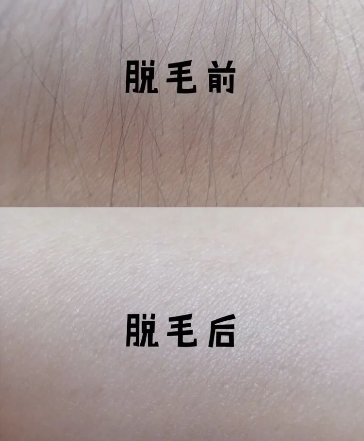 夏季脱毛必备,夏日必备脱毛告别尴尬