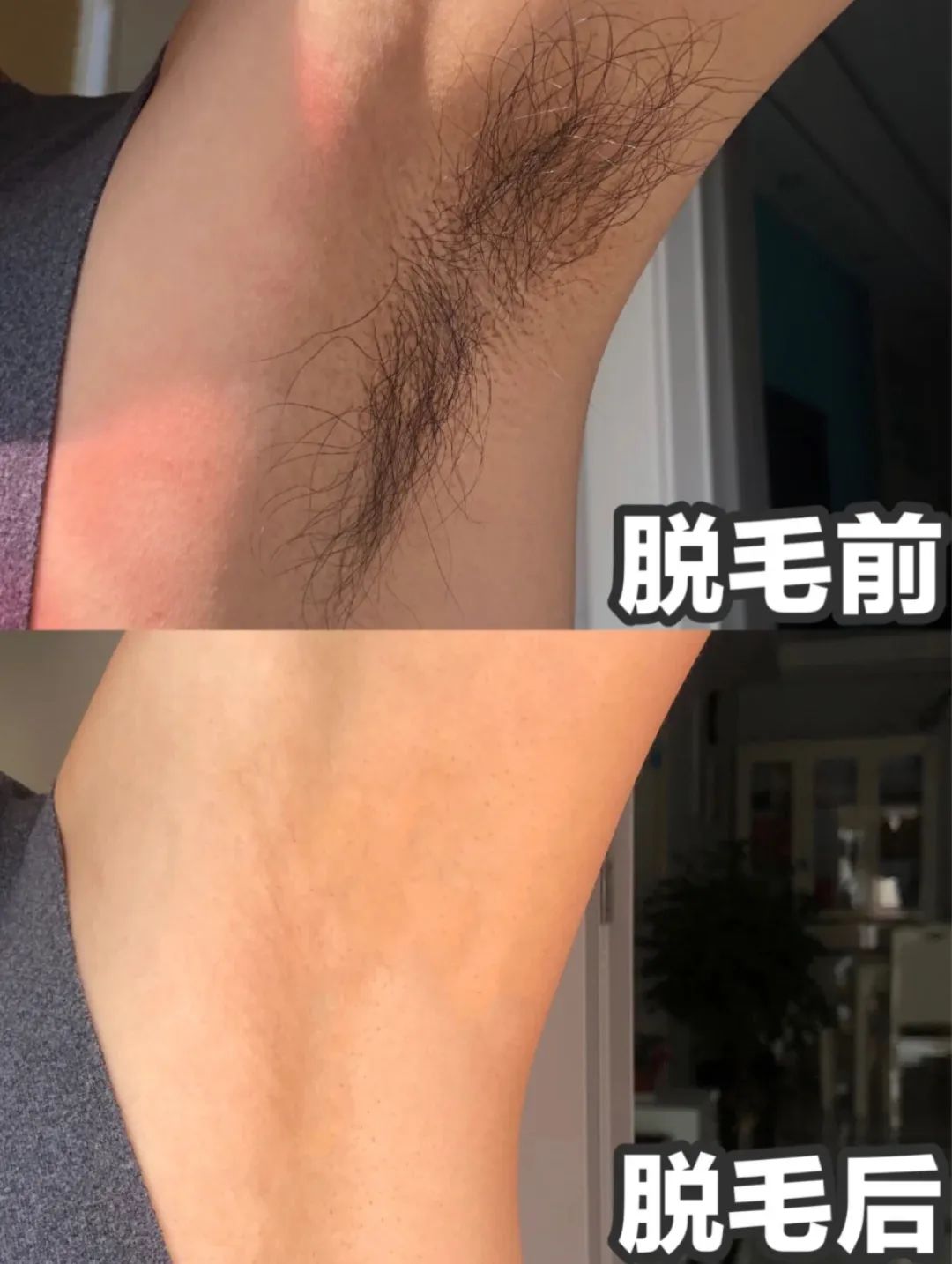 夏季脱毛必备,夏日必备脱毛告别尴尬