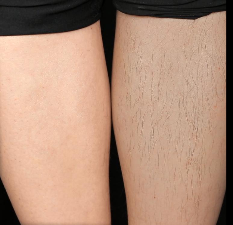 夏季脱毛必备,夏日必备脱毛告别尴尬