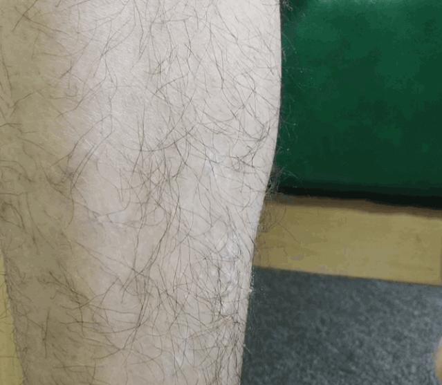 夏季脱毛必备,夏日必备脱毛告别尴尬